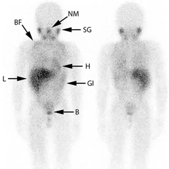 metaiodobenzylguanidine (mibg) scan